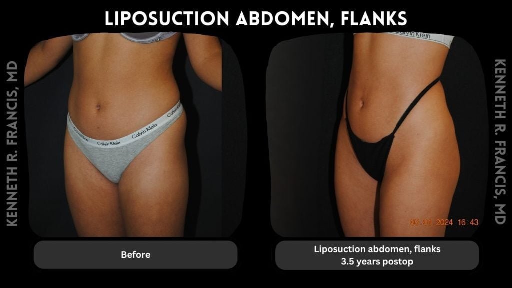 Liposuction abdomen, Flanks 3.5 years postop