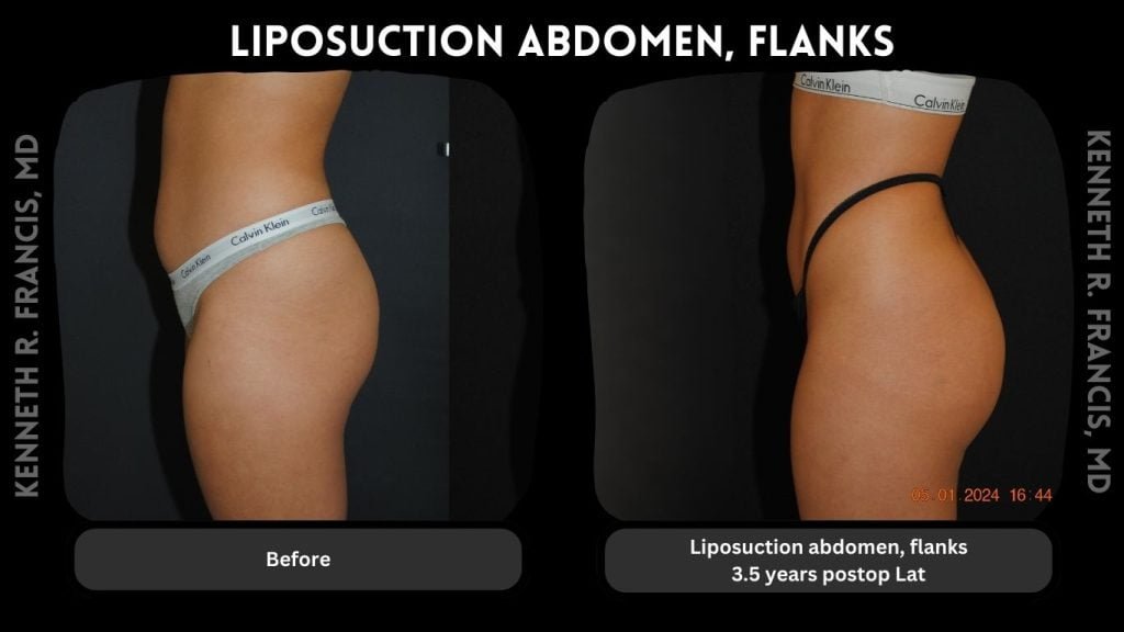 Liposuction abdomen, Flanks 3.5 years postop