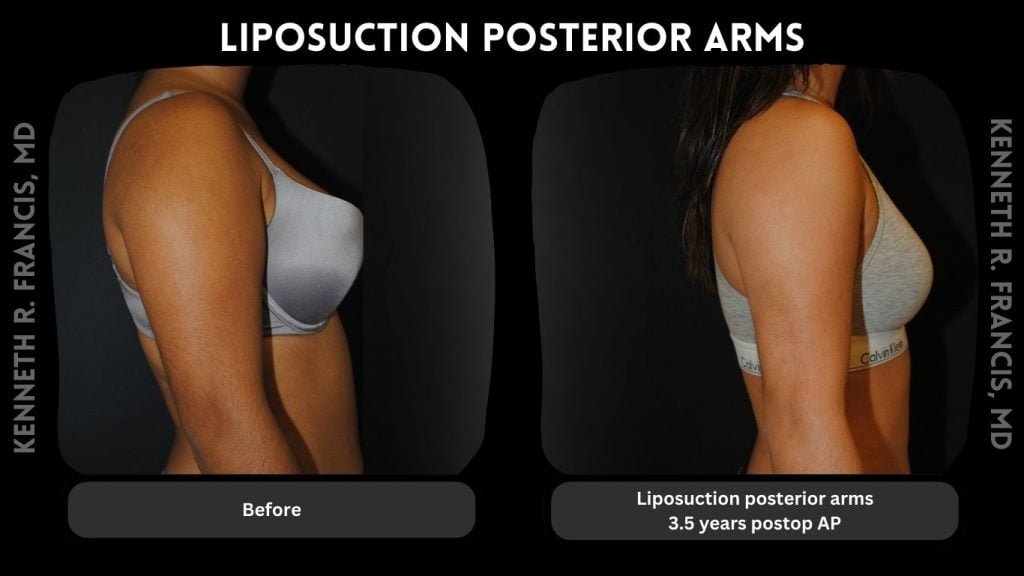 Liposuction posterior arms, 3.5 years postop