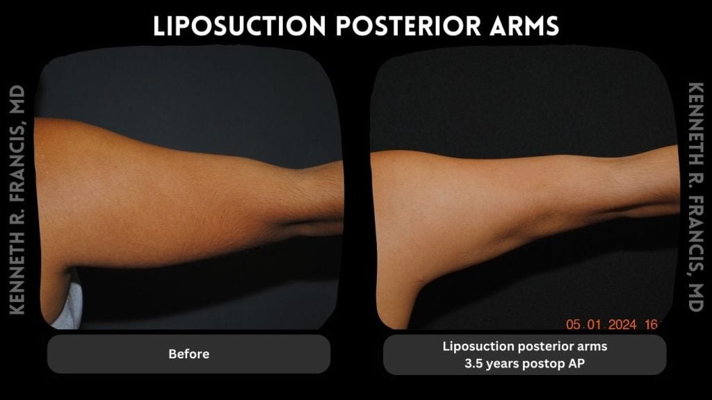 Liposuction posterior arms, 3.5 years postop