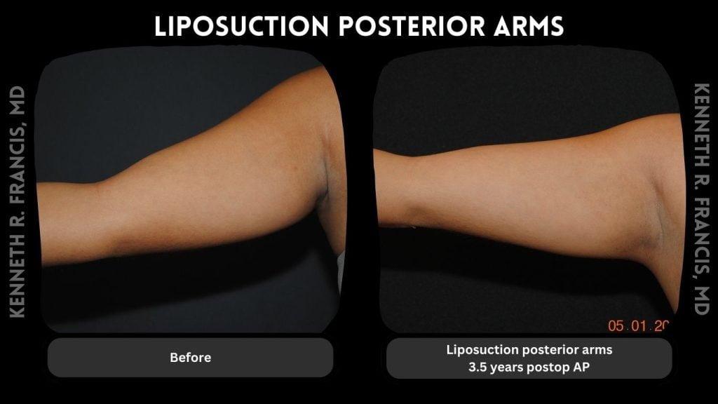 Liposuction posterior arms, 3.5 years postop