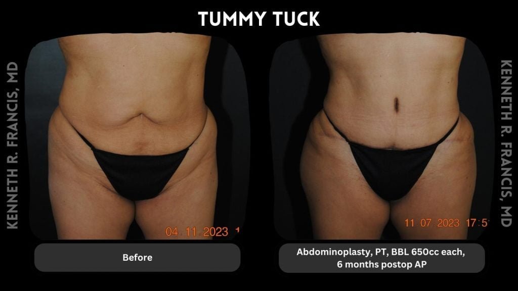 tummy tuck nyc before and after
