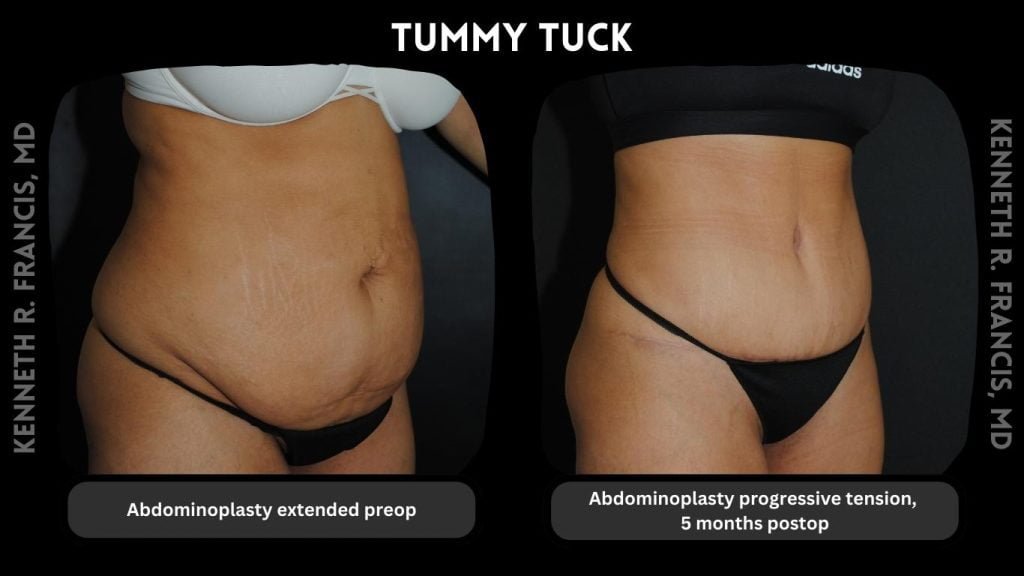 tummy tuck extended nyc before and after