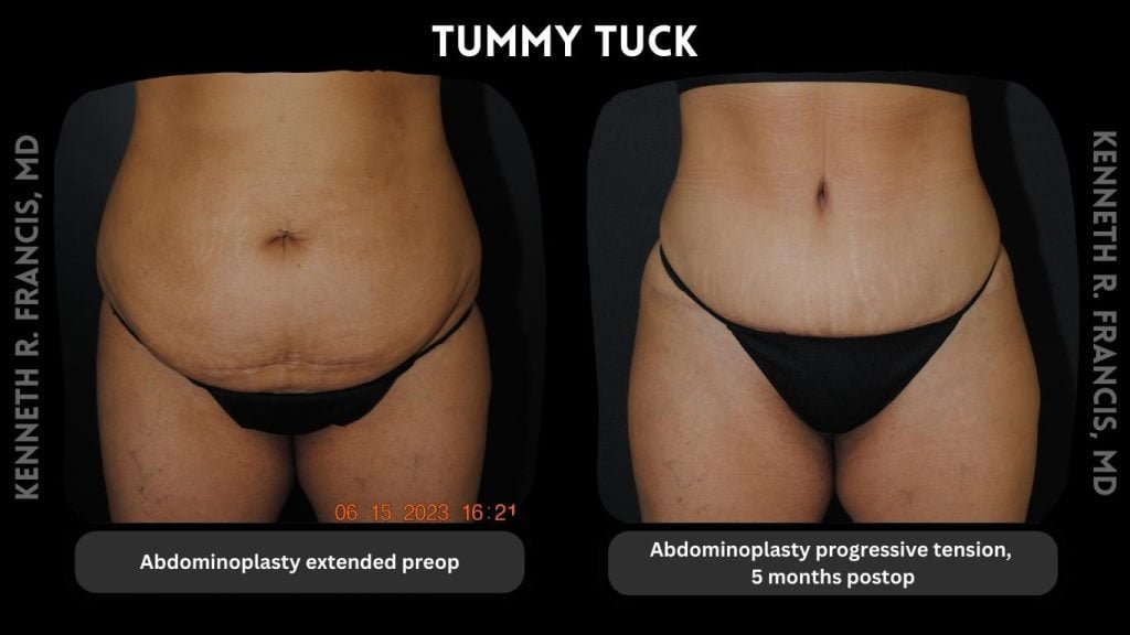 tummy tuck extended nyc before and after